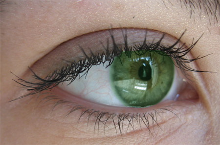 Снижение зрения после попадания дезодоранта в глаз - что делать?